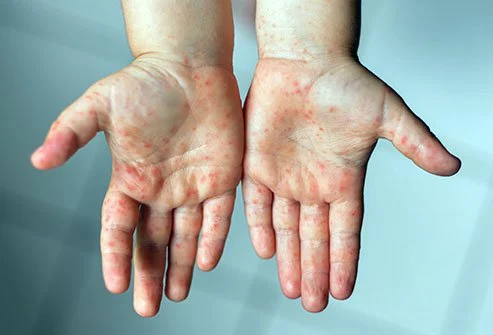 ماذا تعرف عن متلازمة اليد والقدم والفم