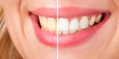 6 طرق لتبييض الأسنان بشكل طبيعي
