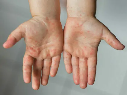 ماذا تعرف عن متلازمة اليد والقدم والفم